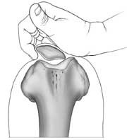 patellar tilt