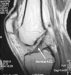 normal acl