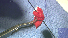 collagen meniscus scaffold loaded with blood