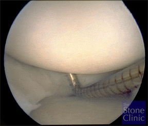 regenerated meniscus after collagen implant