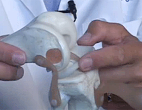 Meniscus cartilage