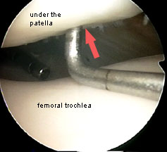 probing the patella