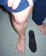 flat feet affecting the kneecap