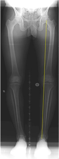 long leg x-ray