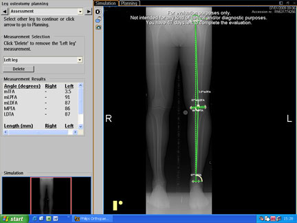 x-rays for high tibial osteotomy