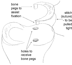 Image showing the technique of meniscal transplant