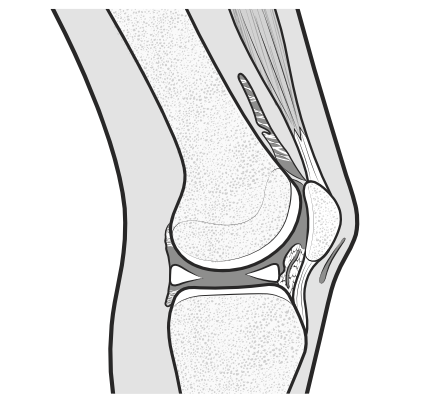 sites of arthrofibrosis in the knee