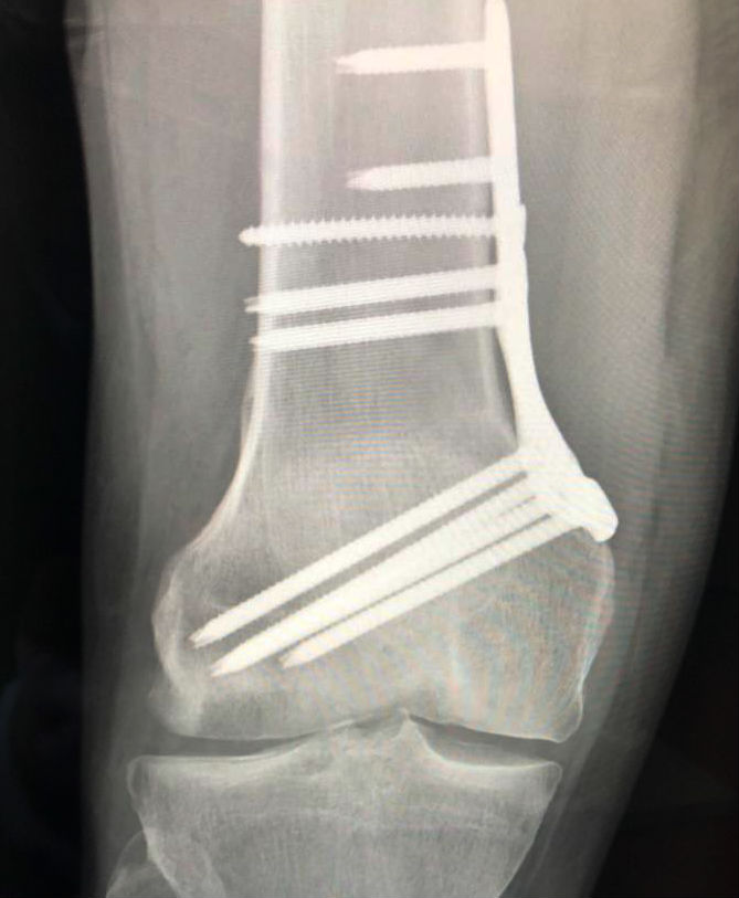 distal femoral osteotomy for osteochondral defect