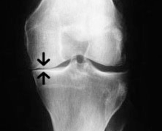 knee joint space narrowing