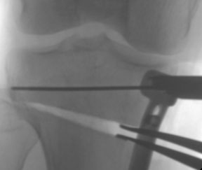 laminar spreaders opening the bone during high tibial osteotomy