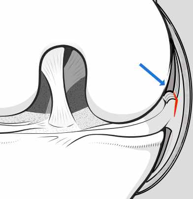 tear of the meniscocapsular junction