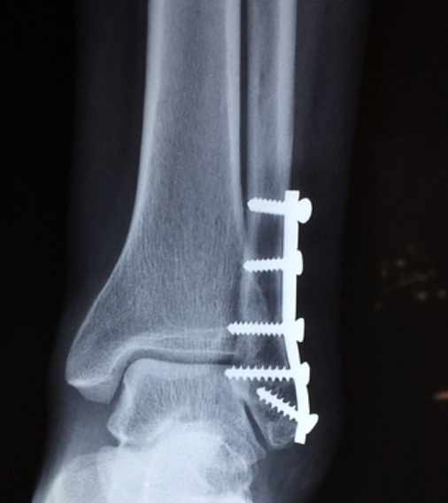open fracture reduction at ankle
