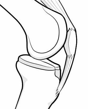 patella tracking within trochlear groove