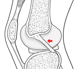 posterior cruciate ligament