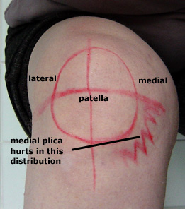 site of pain from a synovial plica on the medial side of the knee