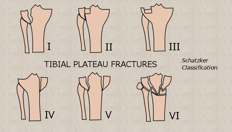 Schatzker classification of tibial plateau fractures