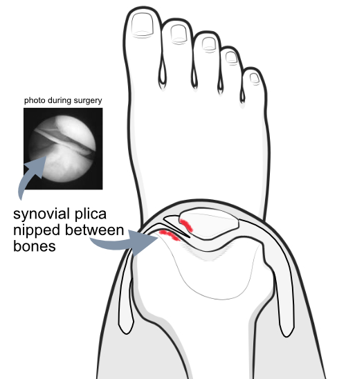 synovial plica being nipped