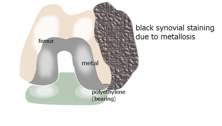 What are the common symptoms of metallosis?