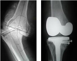 knee replacement