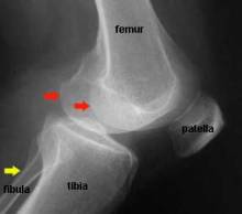 poor x ray of knee