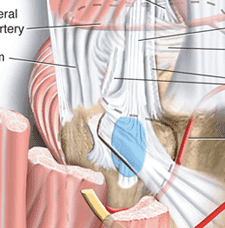 anatomy exposed to show relationship of biceps to the posterolateral corner