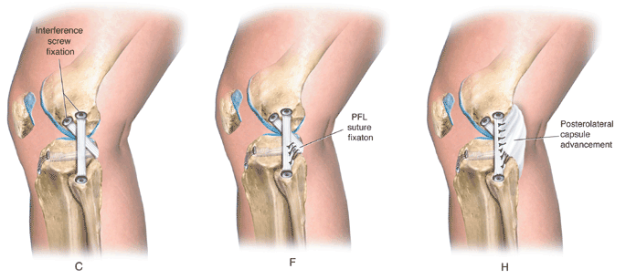 popliteus and fcl grafts