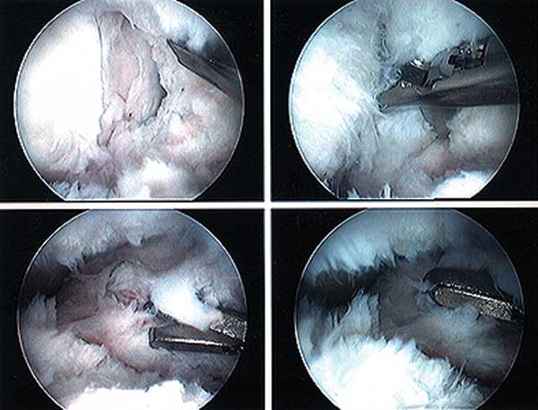 arthrofibrosis of the knee seen via the arthroscope