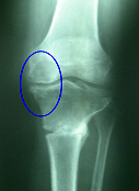after high tibial osteotomy