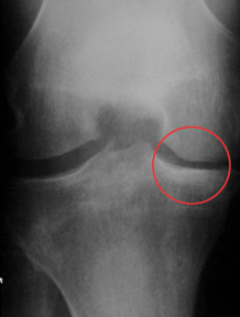 X-ray showing improved joint space