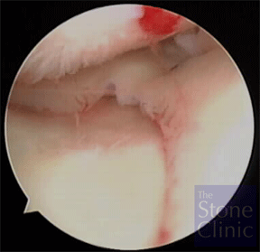 meniscal allograft in place