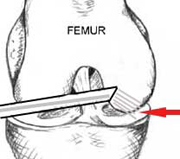 arthroscopy of meniscus