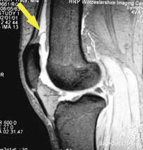 RI of knee showing plica