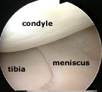 femoral condyle