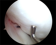 Cartilage softening over ocd