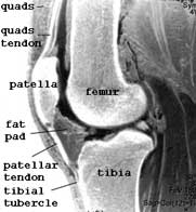 MRI image of knee bones