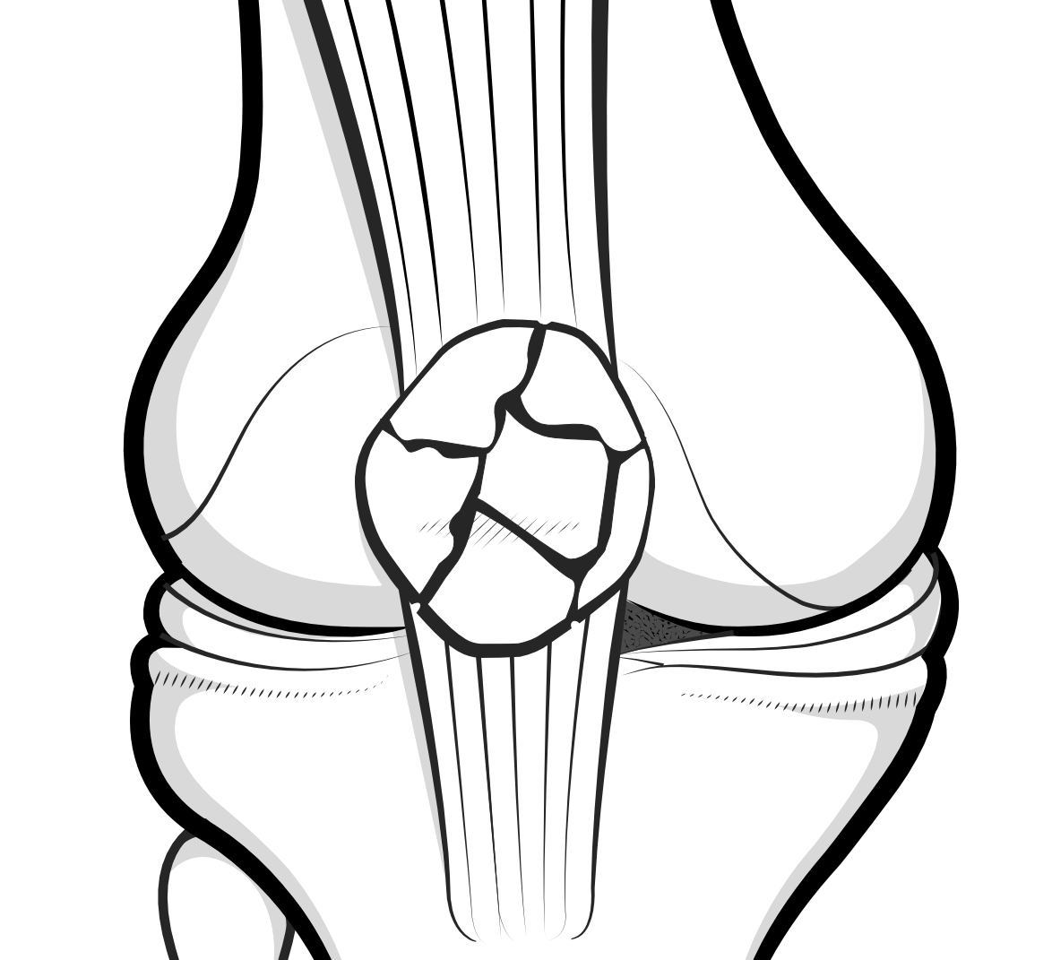 comminuted fracture of the patella
