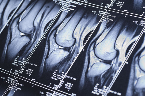 MRI sequence of knee