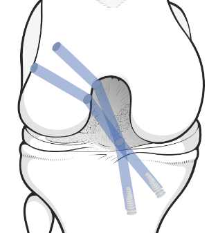 double-bundle ACL reconstruction