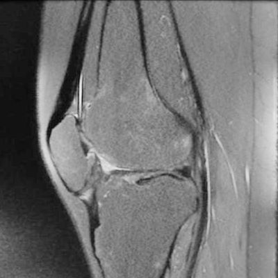 patella baja after arthrofibrosis