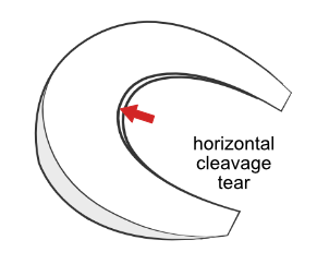 horizontal cleavage tear of the meniscus