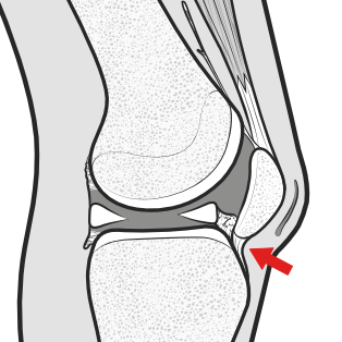 infrapatellar contracture