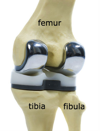 total knee replacement