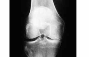joint line thinning on the medial side of the knee