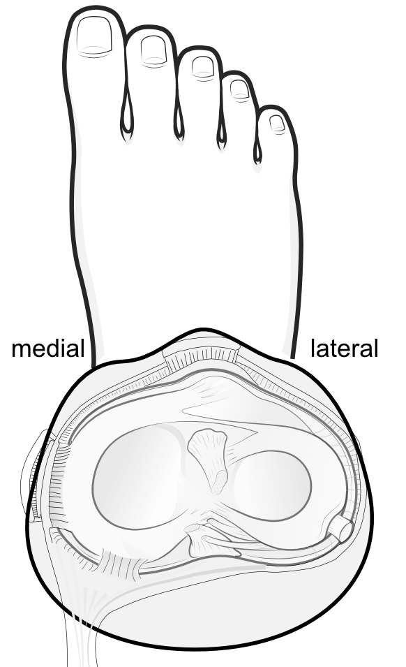 menisci on top of tibial plateau