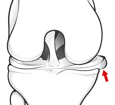 meniscus extrusion