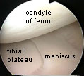 meniscus at arthroscopy