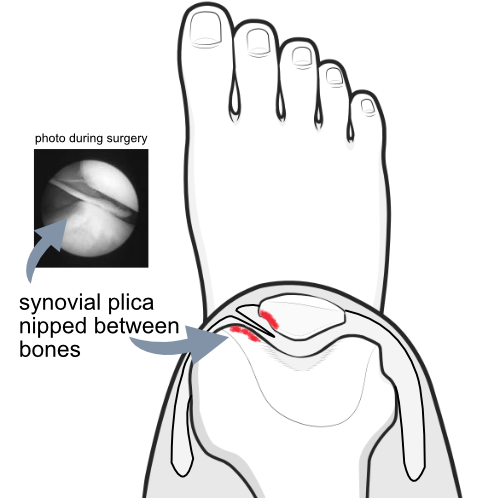 medial plica nipped in the knee joint