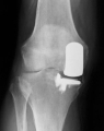 partial knee replacement