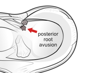 posterior root avulsion of the meniscus