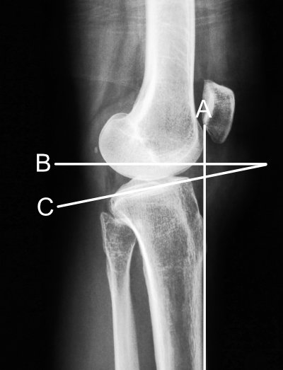 posterior tibial slope